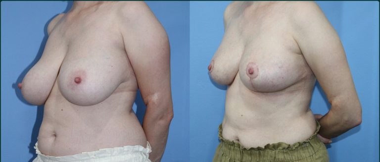Breast reduction before and after, female patient, case BRR-L07, Dr Rohit Kumar, Sydney