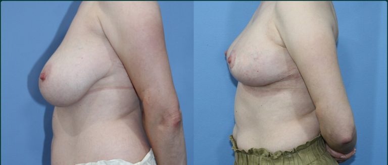 Breast reduction before and after, female patient, case BRR-L07, Dr Rohit Kumar, Sydney