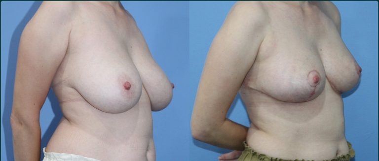 Breast reduction before and after, female patient, case BRR-L07, Dr Rohit Kumar, Sydney