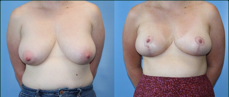 Breast reduction before and after, female patient, case BRR-L08, Dr Rohit Kumar, Sydney