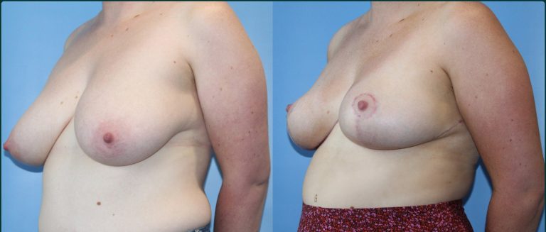Breast reduction before and after, female patient, case BRR-L08, Dr Rohit Kumar, Sydney