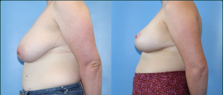 Breast reduction before and after, female patient, case BRR-L08, Dr Rohit Kumar, Sydney