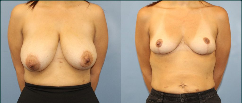 Breast reduction before and after, female patient, case BRR-L09, Dr Rohit Kumar, Sydney