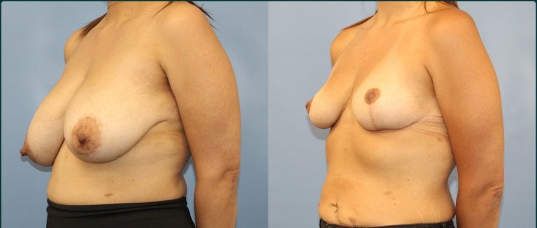 Breast reduction before and after, female patient, case BRR-L09, Dr Rohit Kumar, Sydney