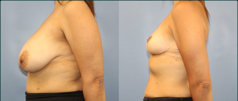 Breast reduction before and after, female patient, case BRR-L09, Dr Rohit Kumar, Sydney