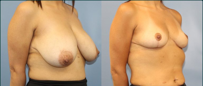 Breast reduction before and after, female patient, case BRR-L09, Dr Rohit Kumar, Sydney