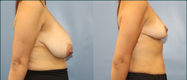 Breast reduction before and after, female patient, case BRR-L09, Dr Rohit Kumar, Sydney