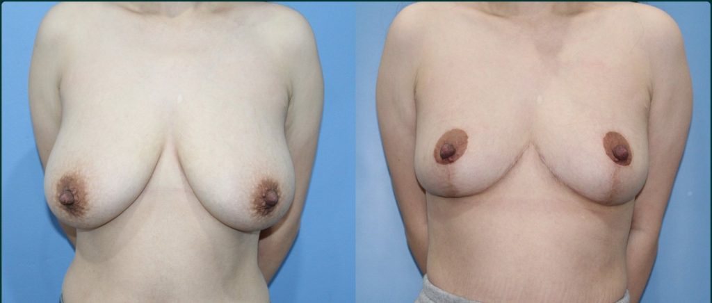 Breast reduction before and after, female patient, case BRR-L10, Dr Rohit Kumar, Sydney