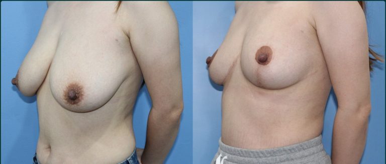 Breast reduction before and after, female patient, case BRR-L10, Dr Rohit Kumar, Sydney