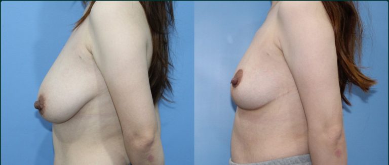 Breast reduction before and after, female patient, case BRR-L10, Dr Rohit Kumar, Sydney