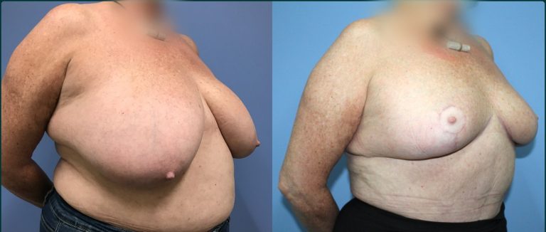 Breast reduction before and after, 45° right view, female patient, case BRR-L11, Dr Rohit Kumar, Sydney