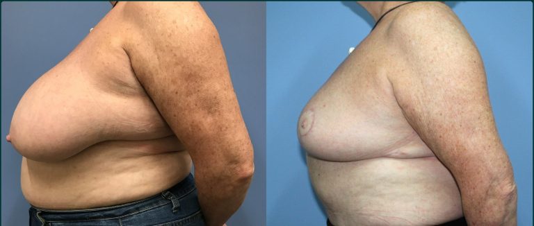 Breast reduction before and after, 90° left view, female patient, case BRR-L11, Dr Rohit Kumar, Sydney