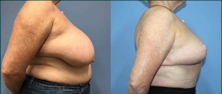 Breast reduction before and after, 90° right view, female patient, case BRR-L11, Dr Rohit Kumar, Sydney