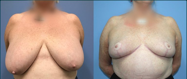 Breast reduction before and after, front view, female patient, case BRR-L11, Dr Rohit Kumar, Sydney