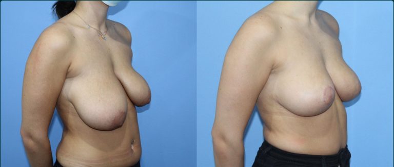 Breast reduction before and after, 45° right view, female patient, case BRR-L12, Dr Rohit Kumar, Sydney