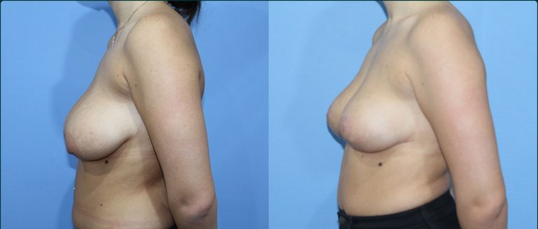 Breast reduction before and after, 90° left view, female patient, case BRR-L12, Dr Rohit Kumar, Sydney