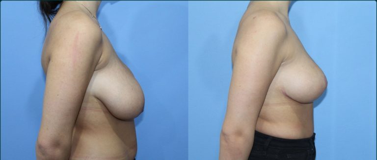 Breast reduction before and after, 90° right view, female patient, case BRR-L12, Dr Rohit Kumar, Sydney