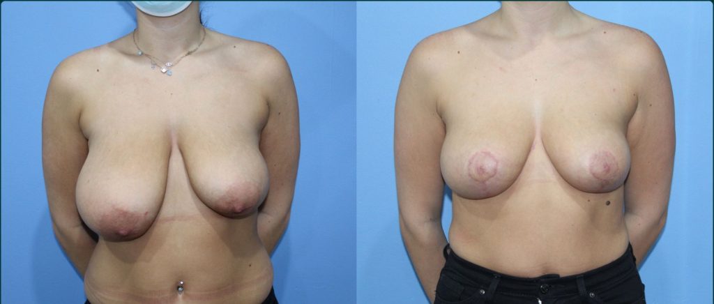 Breast reduction before and after, front view, female patient, case BRR-L12, Dr Rohit Kumar, Sydney