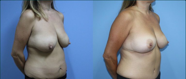 Breast reduction before and after, 45° right view, female patient, case BRR-L13, Dr Rohit Kumar, Sydney