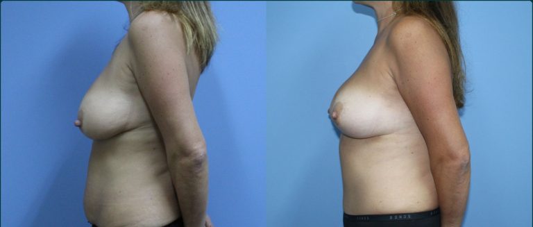 Breast reduction before and after, 90° left view, female patient, case BRR-L13, Dr Rohit Kumar, Sydney