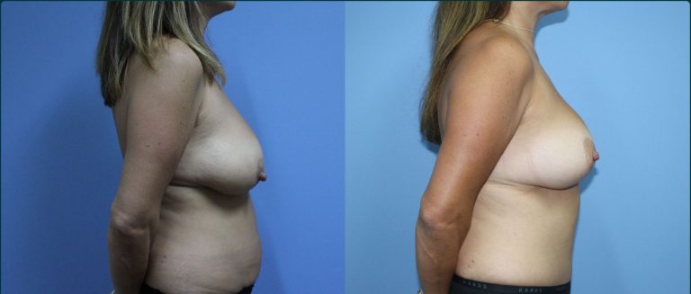 Breast reduction before and after, 90° right view, female patient, case BRR-L13, Dr Rohit Kumar, Sydney