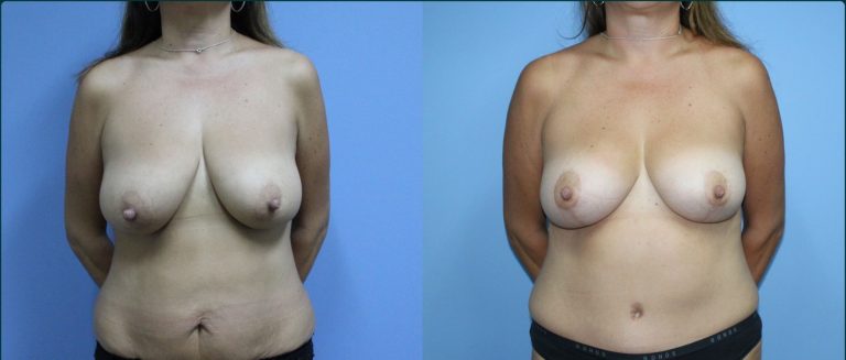 Breast reduction before and after, front view, female patient, case BRR-L13, Dr Rohit Kumar, Sydney