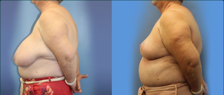 Breast reduction before and after, 90° left view, female patient, case BRR-L14, Dr Rohit Kumar, Sydney