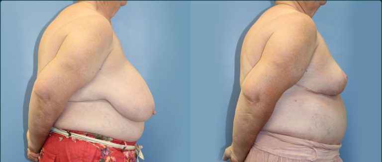 Breast reduction before and after, 90° right view, female patient, case BRR-L14, Dr Rohit Kumar, Sydney