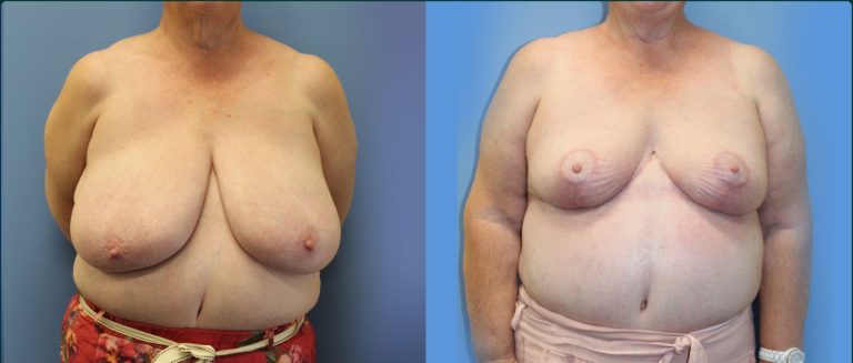 Breast reduction before and after, front view, female patient, case BRR-L14, Dr Rohit Kumar, Sydney