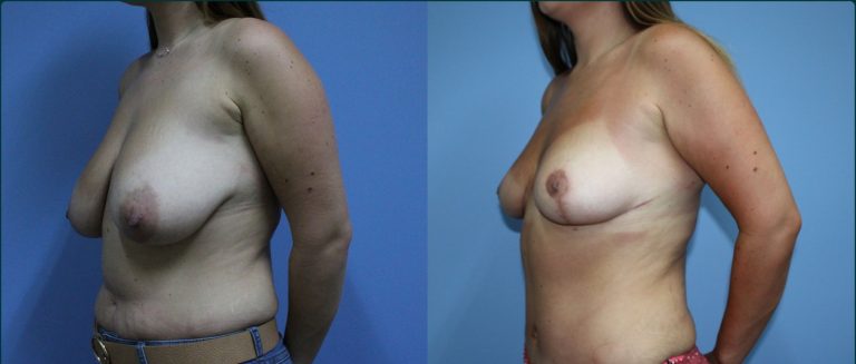 Breast reduction before and after, 45° left view, female patient, case BRR-L15, Dr Rohit Kumar, Sydney
