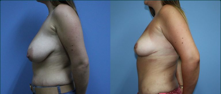 Breast reduction before and after, 90° left view, female patient, case BRR-L15, Dr Rohit Kumar, Sydney