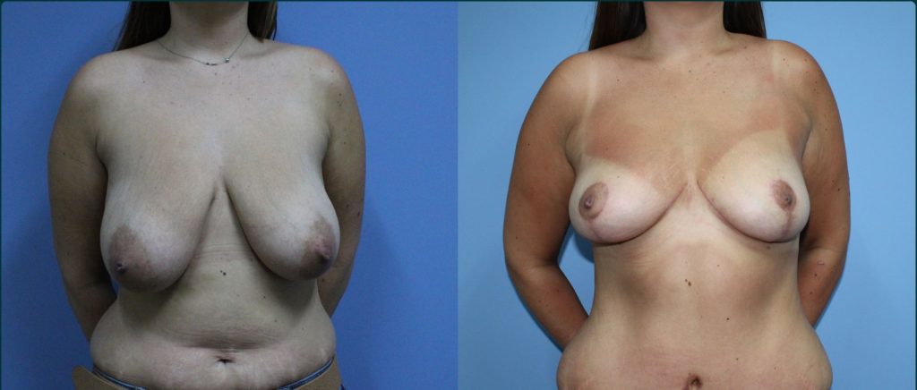 Breast reduction before and after, front view, female patient, case BRR-L15, Dr Rohit Kumar, Sydney