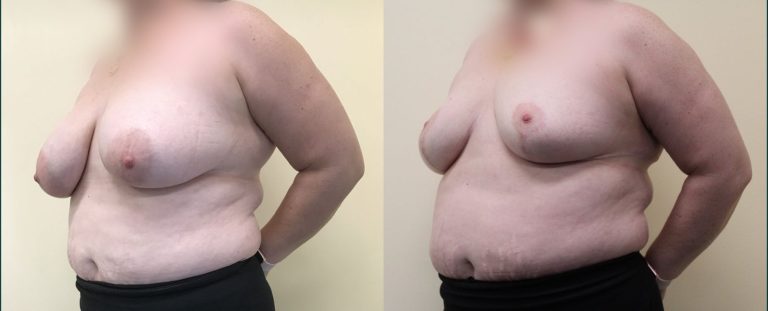 Breast reduction before and after, 45° left view, female patient, case BRR-L16, Dr Rohit Kumar, Sydney