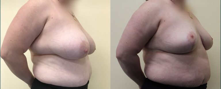 Breast reduction before and after, 45° right view, female patient, case BRR-L16, Dr Rohit Kumar, Sydney