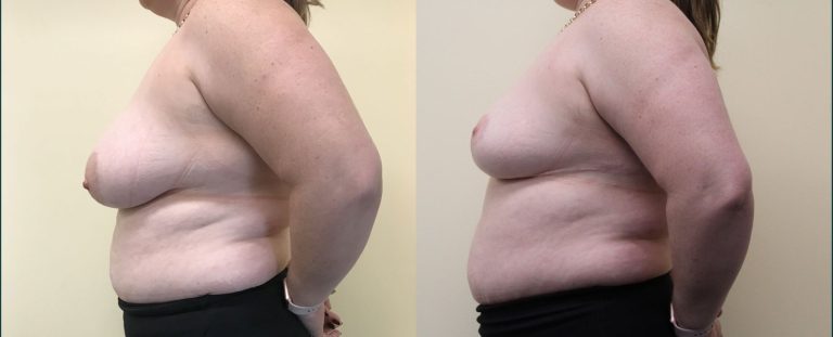 Breast reduction before and after, 90° left view, female patient, case BRR-L16, Dr Rohit Kumar, Sydney