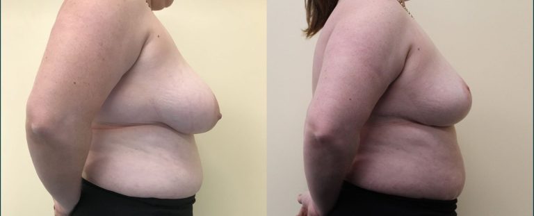 Breast reduction before and after, 90° right view, female patient, case BRR-L16, Dr Rohit Kumar, Sydney