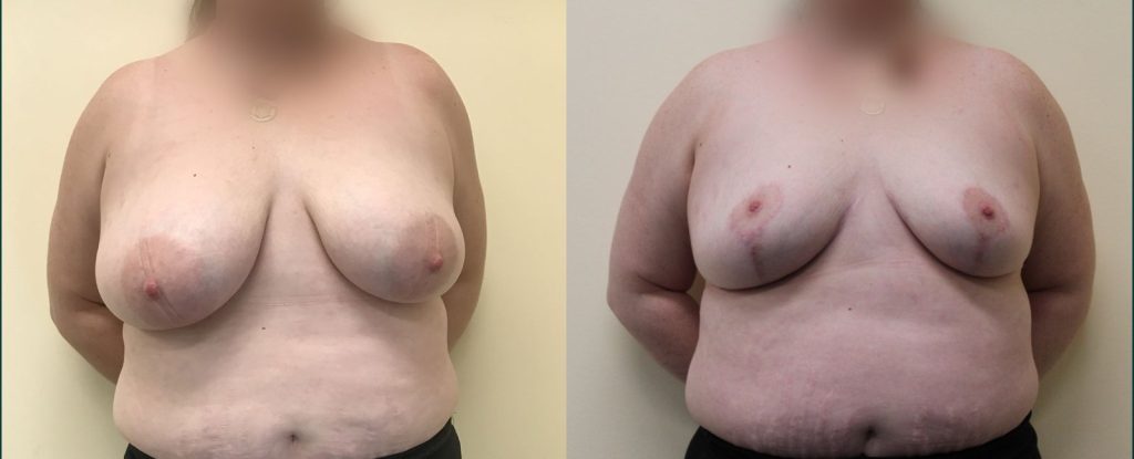 Breast reduction before and after, front view, female patient, case BRR-L16, Dr Rohit Kumar, Sydney