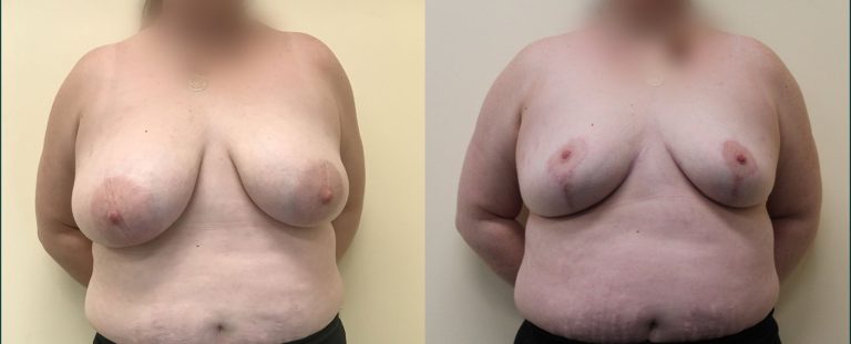 Breast reduction before and after, front view, female patient, case BRR-L16, Dr Rohit Kumar, Sydney