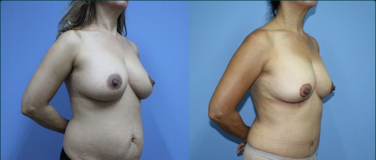 Breast reduction before and after, 45° right view, female patient, case BRR-L17, Dr Rohit Kumar, Sydney
