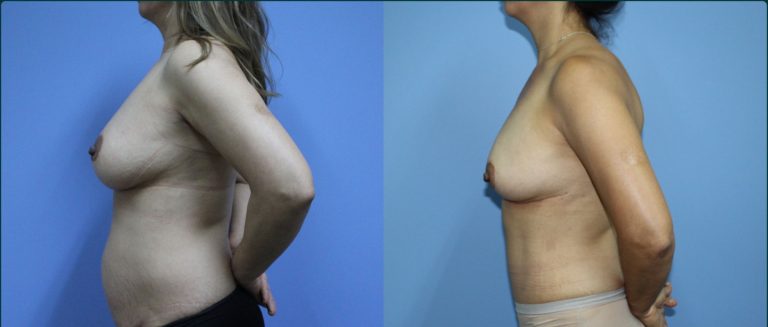 Breast reduction before and after, 90° left view, female patient, case BRR-L17, Dr Rohit Kumar, Sydney