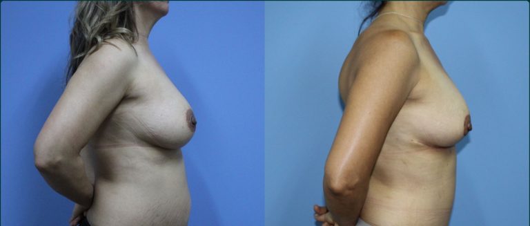 Breast reduction before and after, 90° right view, female patient, case BRR-L17, Dr Rohit Kumar, Sydney