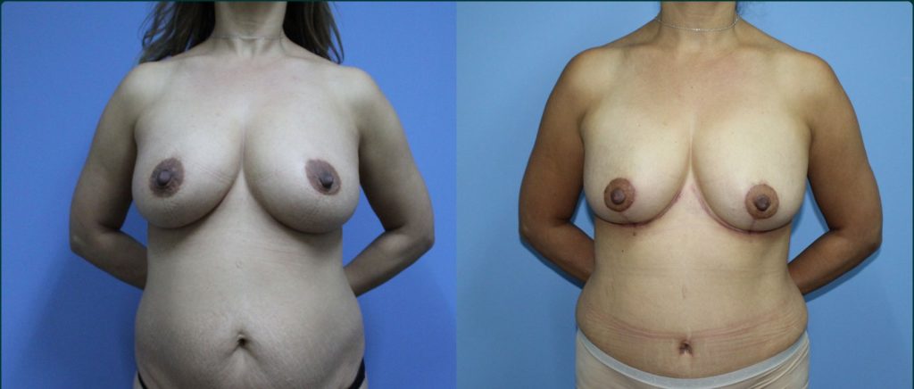 Breast reduction before and after, front view, female patient, case BRR-L17, Dr Rohit Kumar, Sydney