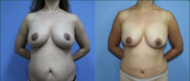 Breast reduction before and after, front view, female patient, case BRR-L17, Dr Rohit Kumar, Sydney