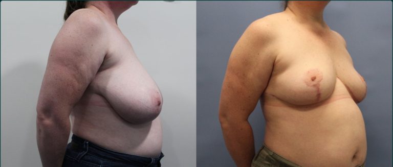 Breast reduction before and after, 45° right view, female patient, case BRR-L18, Dr Rohit Kumar, Sydney