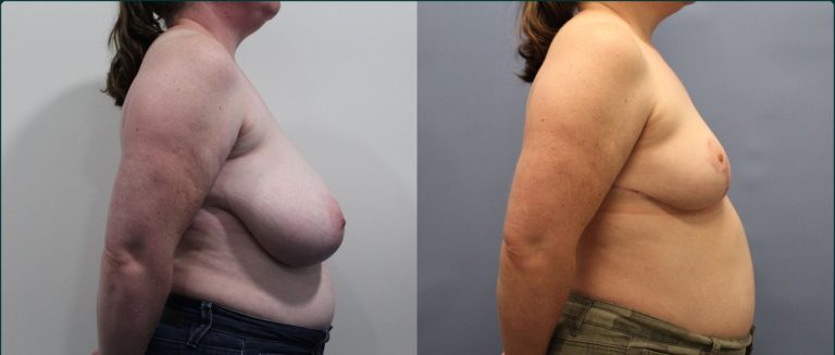 Breast reduction before and after, 90° right view, female patient, case BRR-L18, Dr Rohit Kumar, Sydney
