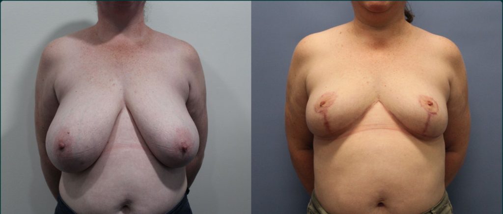 Breast reduction before and after, front view, female patient, case BRR-L18, Dr Rohit Kumar, Sydney