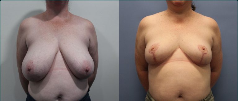 Breast reduction before and after, front view, female patient, case BRR-L18, Dr Rohit Kumar, Sydney