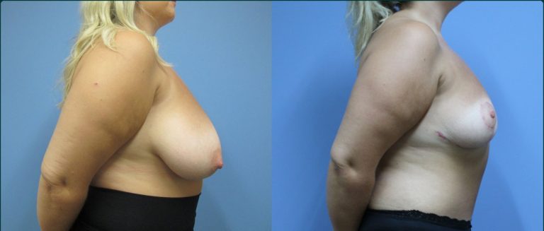 Breast reduction before and after, 90° right view, female patient, case BRR-L19, Dr Rohit Kumar, Sydney