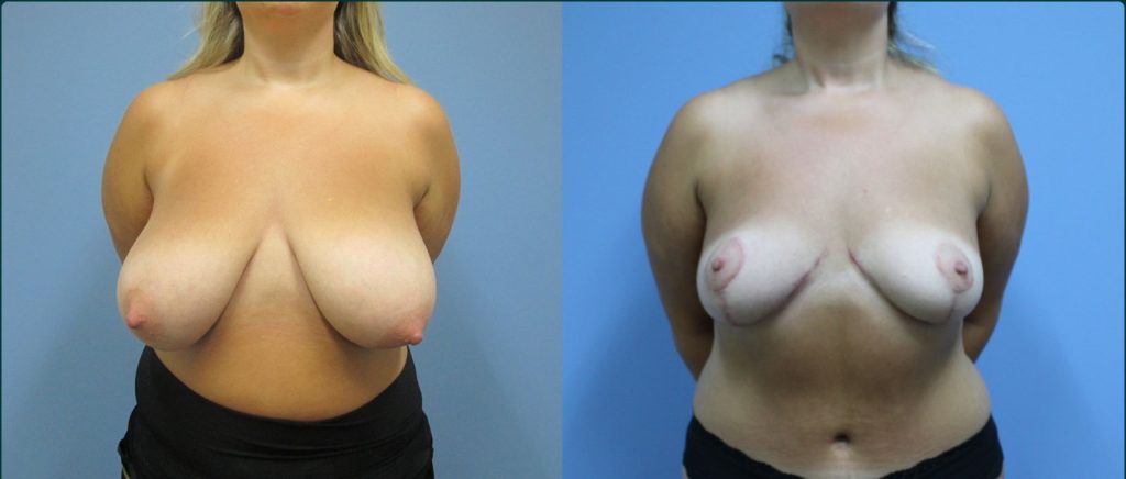 Breast reduction before and after, front view, female patient, case BRR-L19, Dr Rohit Kumar, Sydney