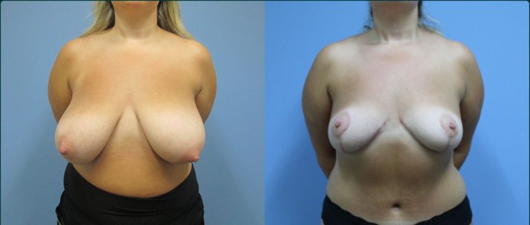 Breast reduction before and after, front view, female patient, case BRR-L19, Dr Rohit Kumar, Sydney